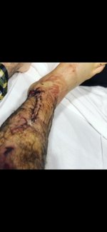 mangled ankle.jpg